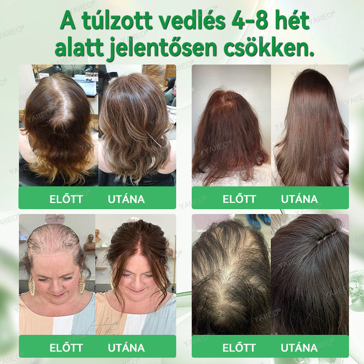 🌿 𝒀𝑨𝑰𝑰𝑬𝑶® 𝑯𝒂𝒋𝒔𝒆𝒓𝒌𝒆𝒏𝒕ő 𝑺𝒛é𝒓𝒖𝒎 – 𝑭á𝒋𝒅𝒂𝒍𝒐𝒎𝒎𝒆𝒏𝒕𝒆𝒔 𝑯𝒂𝒋á𝒑𝒐𝒍á𝒔 Közvetlenül a hajhagymák gyökeréig · 4 hét alatt újraéleszti az alvó tüszőket · EU CE tanúsítvány