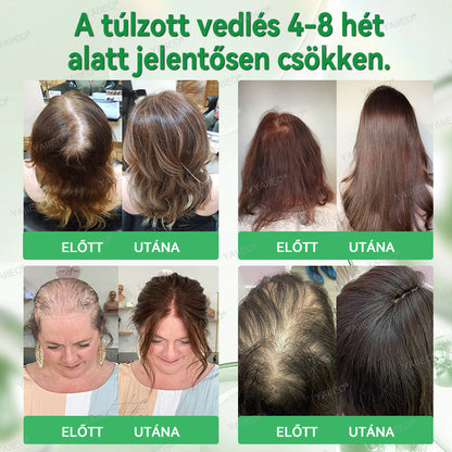 🌿 𝒀𝑨𝑰𝑰𝑬𝑶® 𝑯𝒂𝒋𝒔𝒆𝒓𝒌𝒆𝒏𝒕ő 𝑺𝒛é𝒓𝒖𝒎 – 𝑭á𝒋𝒅𝒂𝒍𝒐𝒎𝒎𝒆𝒏𝒕𝒆𝒔 𝑯𝒂𝒋á𝒑𝒐𝒍á𝒔 Közvetlenül a hajhagymák gyökeréig · 4 hét alatt újraéleszti az alvó tüszőket · EU CE tanúsítvány