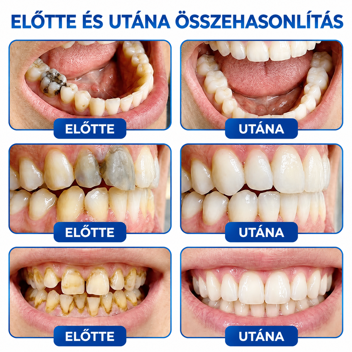 🌟PuraCure®  Üregjavító Természetes Zománctömő Gél