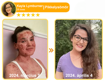 🔥🔥 Bőrgyógyász ajánlása ✨ ZödVita® Méhméreg Bőr Helyreállító Krém – Időskori purpura, ráncok és a bőr állapotának látványos javítása 💜 Magyar fejlesztés, magyarországi gyártás és szállítás