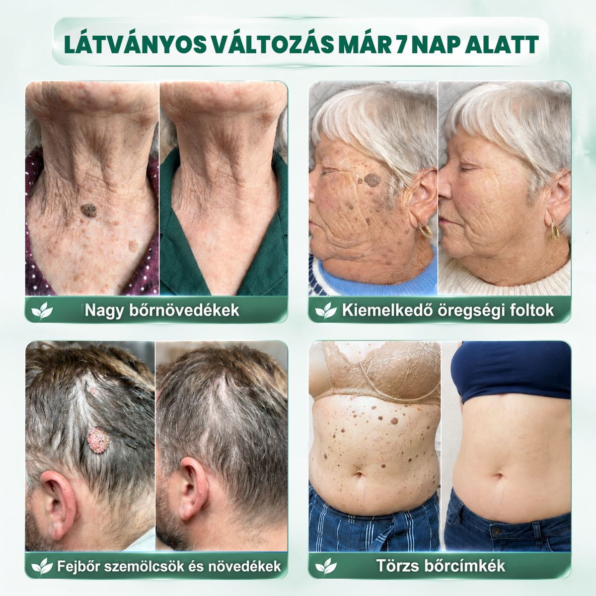 𝐏𝐮𝐫𝐚𝐂𝐮𝐫𝐞® 𝐌𝐈𝐊𝐑𝐎𝐓Ű𝐒 𝐁Ő𝐑𝐊𝐈𝐍Ö𝐕É𝐒-𝐄𝐋𝐓Á𝐕𝐎𝐋Í𝐓Ó 𝐓𝐀𝐏𝐀𝐒𝐙𝐎𝐊 —𝟕 𝐍𝐀𝐏𝐎𝐒 𝐂É𝐋𝐙𝐎𝐓𝐓 𝐄𝐋𝐓Á𝐕𝐎𝐋Í𝐓Á𝐒 𝐁Ő𝐑𝐍𝐘Ú𝐋𝐕Á𝐍𝐘𝐎𝐊, 𝐒𝐙𝐄𝐌Ö𝐋𝐂𝐒Ö𝐊 É𝐒 𝐊𝐈𝐄𝐌𝐄𝐋𝐊𝐄𝐃Ő 𝐁Ő𝐑𝐇𝐈𝐁Á𝐊 𝐄𝐋𝐋𝐄𝐍