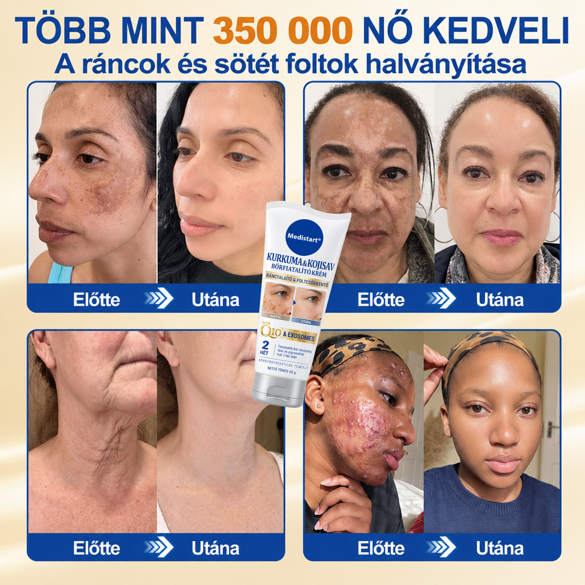 ✨𝑯𝒊𝒗𝒂𝒕𝒂𝒍𝒐𝒔 𝑼̈𝒛𝒍𝒆𝒕 | 𝐔́𝐣! ✨ Medistart® 𝐊𝐮𝐫𝐤𝐮𝐦𝐚 × 𝐊𝐨𝐣𝐢𝐧𝐬𝐚𝐯 𝐄́𝐣𝐬𝐳𝐚𝐤𝐚𝐢 Bőrfiatalító 𝐊𝐫𝐞́𝐦— 𝐇𝐚𝐥𝐯𝐚́𝐧𝐲𝐢́𝐭𝐬𝐝 𝐚 𝐦𝐚𝐤𝐚𝐜𝐬 𝐬𝐨̈𝐭𝐞́𝐭 𝐟𝐨𝐥𝐭𝐨𝐤𝐚𝐭 𝐞́𝐬 𝐬𝐢𝐦𝐢́𝐭𝐬𝐝 𝐤𝐢 𝐚 𝐥𝐚́𝐭𝐡𝐚𝐭𝐨́ 𝐫𝐚́𝐧𝐜𝐨𝐤𝐚𝐭 𝐚𝐥𝐯𝐚́𝐬 𝐤𝐨̈𝐳𝐛𝐞𝐧 🌙 ✅ 𝐄́𝐣𝐬𝐳𝐚𝐤𝐚́𝐧𝐤𝐞́𝐧𝐭 𝐞𝐠𝐲 𝐥𝐞́𝐩𝐞́𝐬 · 𝐋𝐚́𝐭𝐡𝐚𝐭𝐨́ 𝐯𝐚́𝐥𝐭𝐨𝐳𝐚́𝐬 𝟕 𝐞́𝐣𝐬𝐳𝐚𝐤𝐚 𝐚𝐥𝐚𝐭𝐭 💯