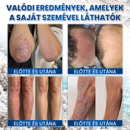 💖 Medistart® PSZORIÁZIS SPECIÁLIS BŐRÁPOLÓ