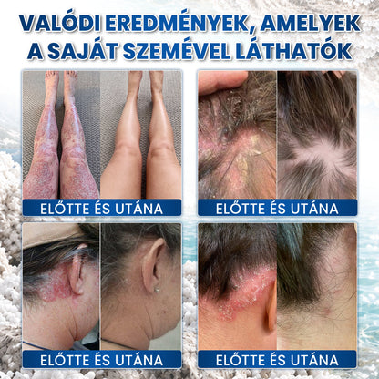 💖 Medistart® PSZORIÁZIS SPECIÁLIS BŐRÁPOLÓ