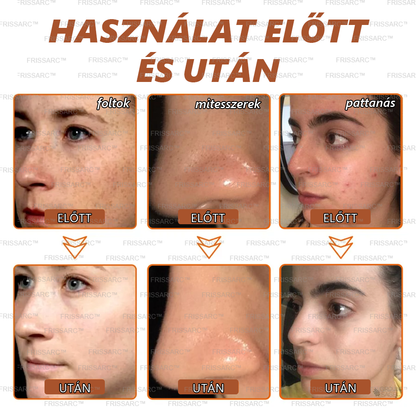 🎁𝐅𝐑𝐈𝐒𝐒𝐀𝐑𝐂™ Arcmaszk | Látható folthalványítás természetes összetevőkkel – szeplőkre, pigmentfoltokra, napkárosodásra🎁