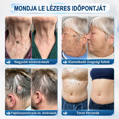 📦PuraCure® 👩‍⚕️ 𝟕 𝐍𝐚𝐩𝐨𝐬 Bőrkinövés- és Folteltávolító Toll Fájdalommentes és Hegmentes Professzionális Rollerball