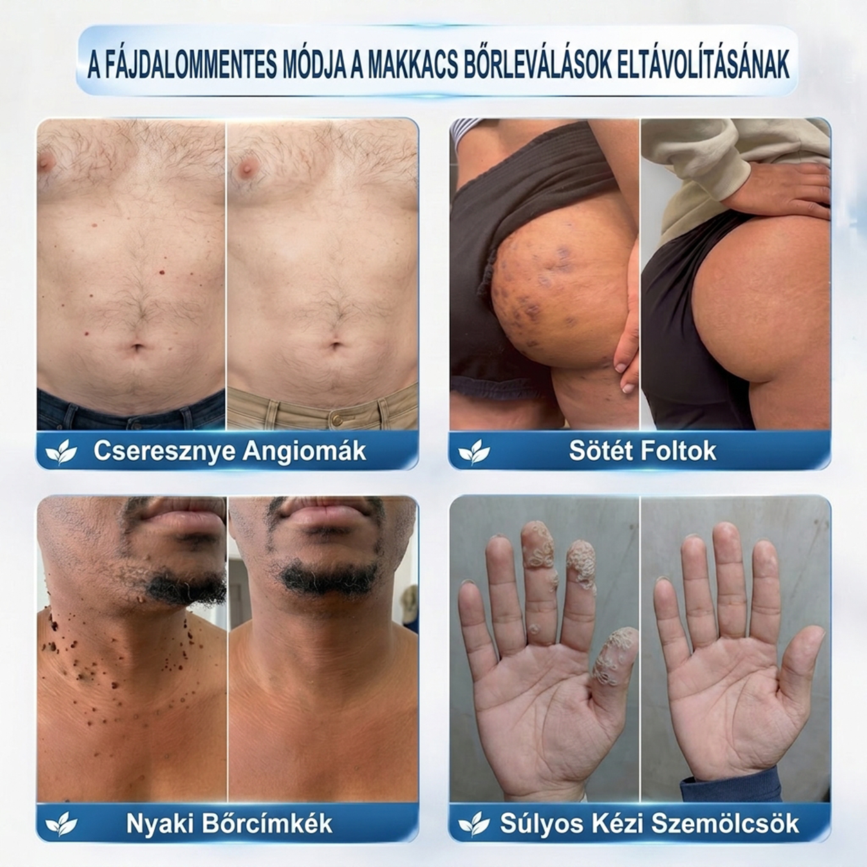 📦PuraCure® 👩‍⚕️ 𝟕 𝐍𝐚𝐩𝐨𝐬 Bőrkinövés- és Folteltávolító Toll Fájdalommentes és Hegmentes Professzionális Rollerball