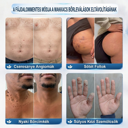 📦PuraCure® 👩‍⚕️ 𝟕 𝐍𝐚𝐩𝐨𝐬 Bőrkinövés- és Folteltávolító Toll Fájdalommentes és Hegmentes Professzionális Rollerball