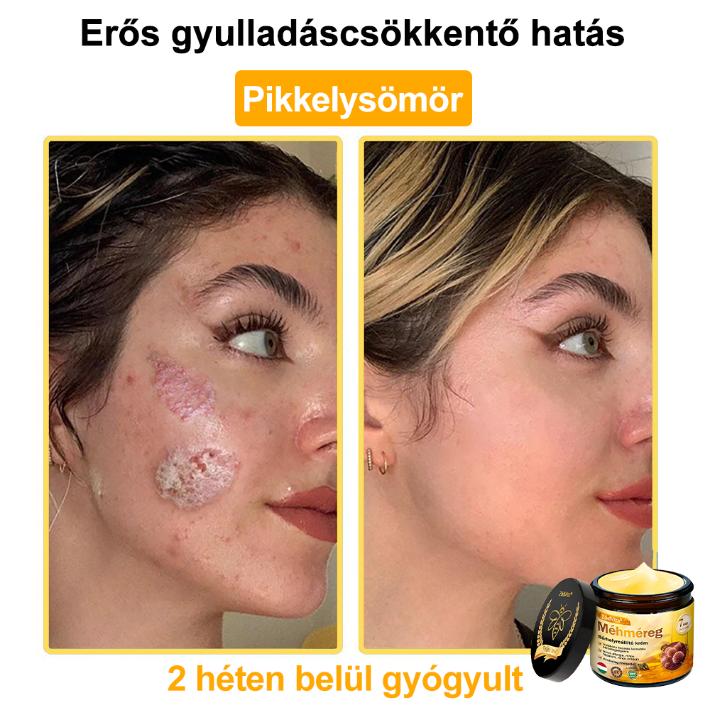 🔥🔥 Bőrgyógyász ajánlása ✨ ZödVita® Méhméreg Bőr Helyreállító Krém – Időskori purpura, ráncok és a bőr állapotának látványos javítása 💜 Magyar fejlesztés, magyarországi gyártás és szállítás