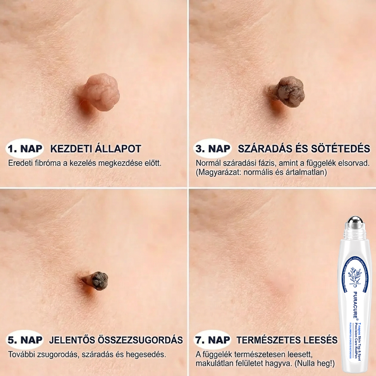 📦PuraCure® 👩‍⚕️ 𝟕 𝐍𝐚𝐩𝐨𝐬 Bőrkinövés- és Folteltávolító Toll Fájdalommentes és Hegmentes Professzionális Rollerball