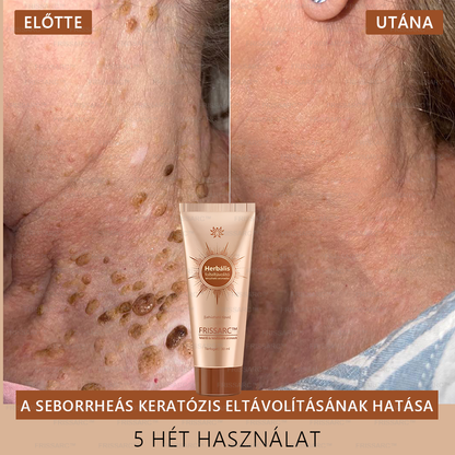 🎁𝐅𝐑𝐈𝐒𝐒𝐀𝐑𝐂™ Arcmaszk | Látható folthalványítás természetes összetevőkkel – szeplőkre, pigmentfoltokra, napkárosodásra🎁