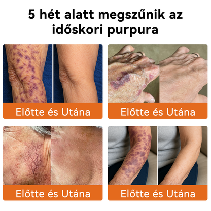 🔥🔥 Bőrgyógyász ajánlása ✨ ZödVita® Méhméreg Bőr Helyreállító Krém – Időskori purpura, ráncok és a bőr állapotának látványos javítása 💜 Magyar fejlesztés, magyarországi gyártás és szállítás