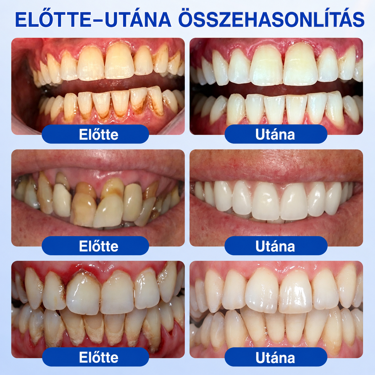 🇭🇺👨‍⚕️🌲🦷 PuraCure® ÍNYMEGÚJÍTÓ – Parodontális helyreállító gél🧂