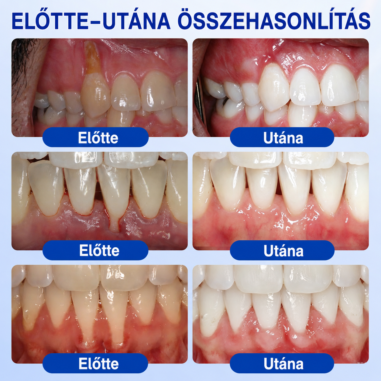 🇭🇺👨‍⚕️🌲🦷 PuraCure® ÍNYMEGÚJÍTÓ – Parodontális helyreállító gél🧂