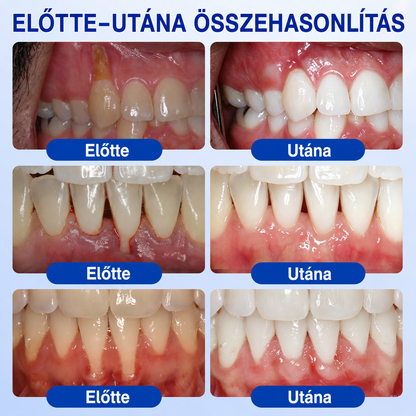 🇭🇺👨‍⚕️🌲🦷 PuraCure® ÍNYMEGÚJÍTÓ – Parodontális helyreállító gél🧂