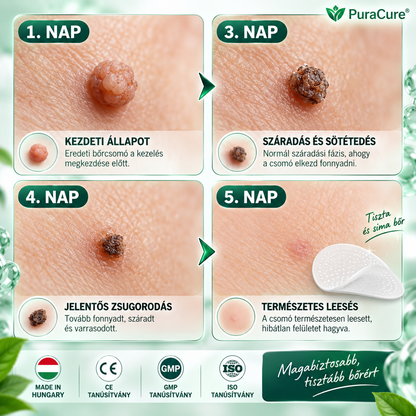 𝐏𝐮𝐫𝐚𝐂𝐮𝐫𝐞® 𝐌𝐈𝐊𝐑𝐎𝐓Ű𝐒 𝐁Ő𝐑𝐊𝐈𝐍Ö𝐕É𝐒-𝐄𝐋𝐓Á𝐕𝐎𝐋Í𝐓Ó 𝐓𝐀𝐏𝐀𝐒𝐙𝐎𝐊 —𝟕 𝐍𝐀𝐏𝐎𝐒 𝐂É𝐋𝐙𝐎𝐓𝐓 𝐄𝐋𝐓Á𝐕𝐎𝐋Í𝐓Á𝐒 𝐁Ő𝐑𝐍𝐘Ú𝐋𝐕Á𝐍𝐘𝐎𝐊, 𝐒𝐙𝐄𝐌Ö𝐋𝐂𝐒Ö𝐊 É𝐒 𝐊𝐈𝐄𝐌𝐄𝐋𝐊𝐄𝐃Ő 𝐁Ő𝐑𝐇𝐈𝐁Á𝐊 𝐄𝐋𝐋𝐄𝐍